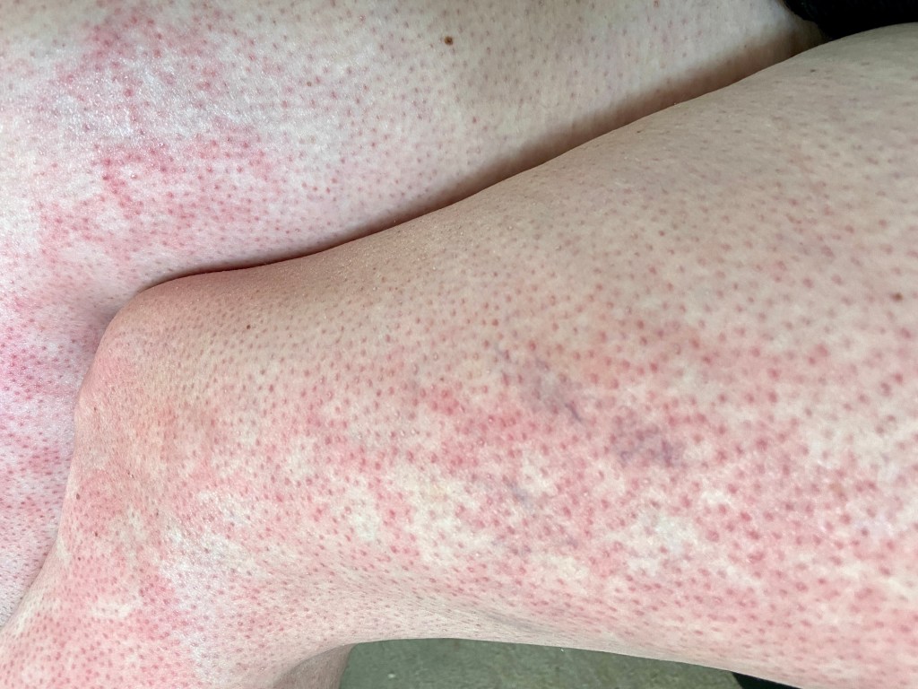 The classic symptom of erythema ab igne is a rash that resembles a fishnet or "like tired" model.